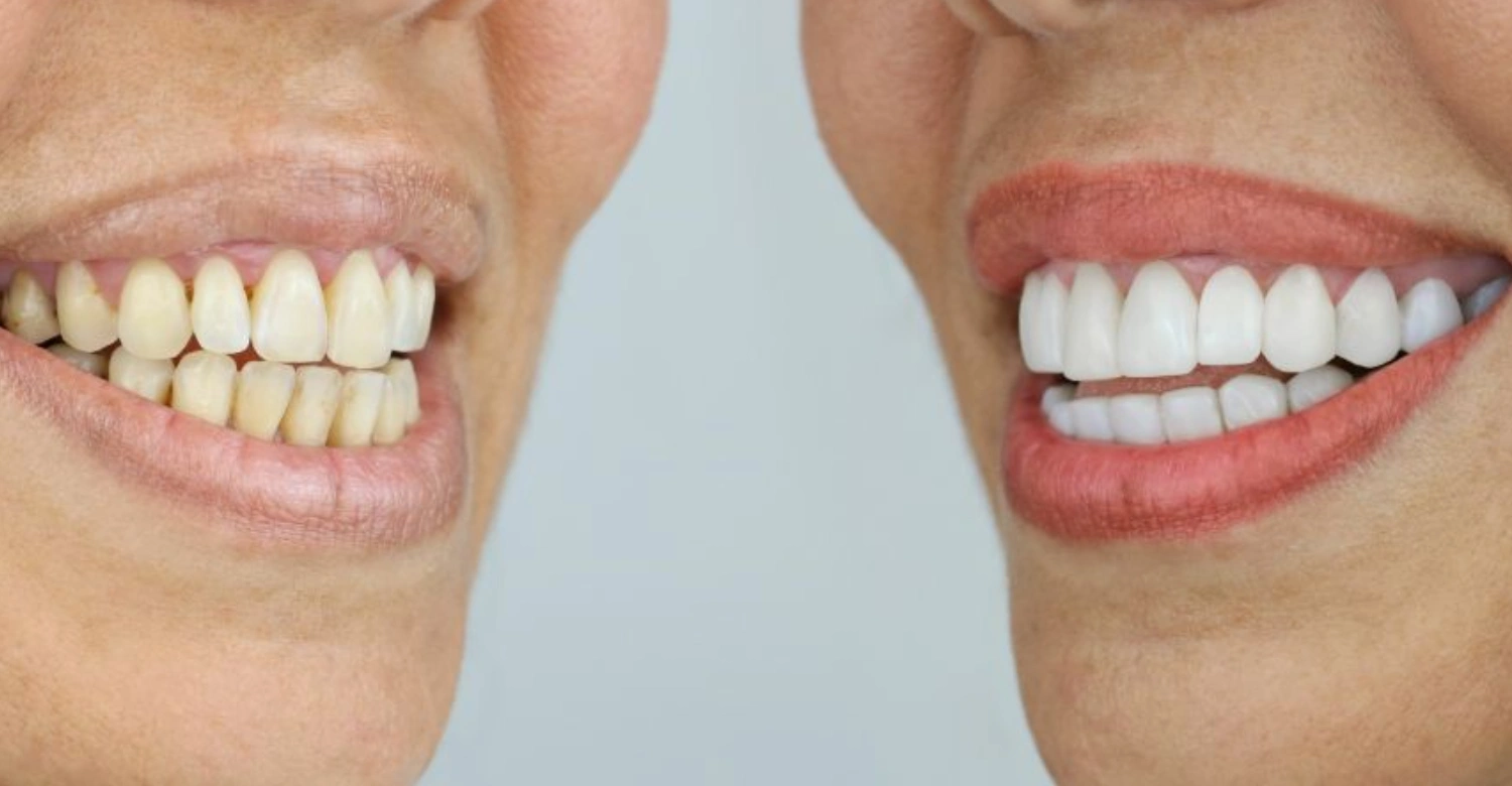 7 Secrets to a Truly Perfect Smile in turkey 2026 from Vitrin Clinic !!